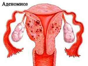 Признаки и лечение гиперплазии эндометрия в менопаузе