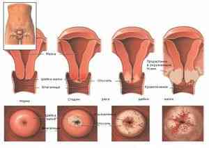 Симптомы рака шейки матки его генетические виды и методы лечения