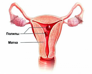 Полип эндометрия и беременность