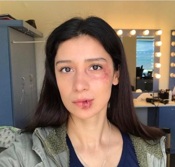 Равшана Куркова показала избитое лицо в Инстаграм