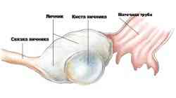 Разрыв кисты яичника: симптомы и основные причины