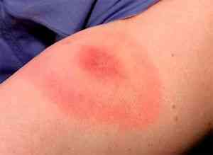 Аллергия на укусы насекомых (фото) и что делать при острой реакции ...
