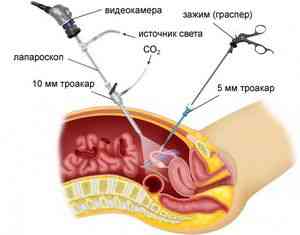 Беременность после лапароскопии яичников